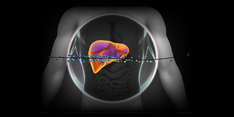 Graphic highlighting the liver in the human body, overlayed with data from the publication showing the established human MASLD trajectory based on patient transcriptomic data.