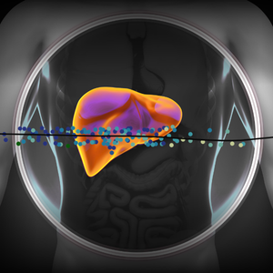 Graphic highlighting the liver in the human body, overlayed with data from the publication showing the established human MASLD trajectory based on patient transcriptomic data.